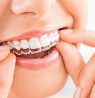 Alinhadores Estéticos